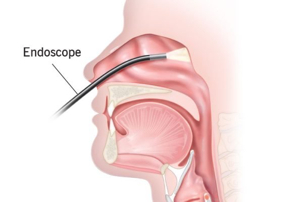 22156-nasal-endoscopy