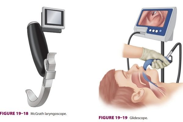 article-Video-Laryngoscopes-LYy