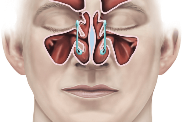 endoscopic-sinus-surgery-illustration-c61add