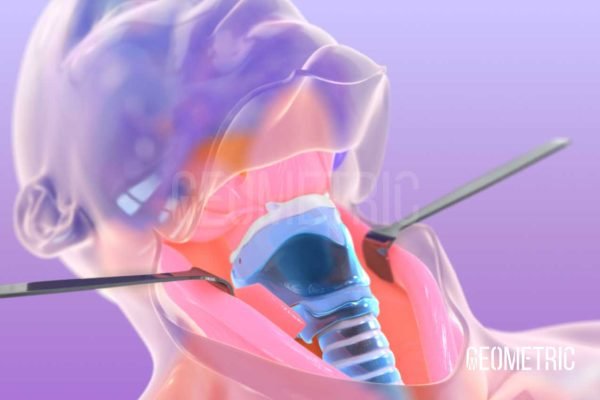 geometric-medical-animation-laryngectomy