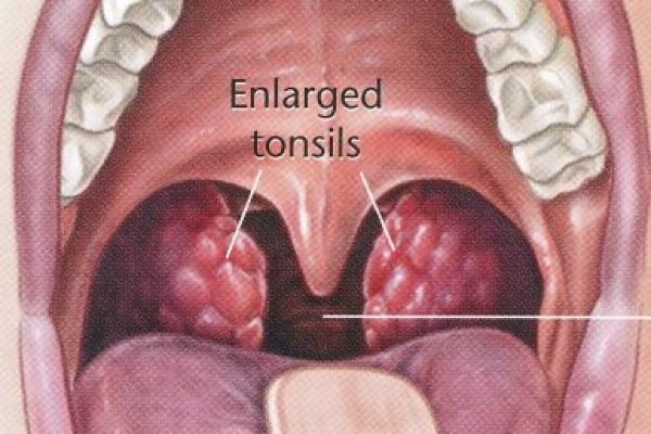 mitec-tonsil-387x510