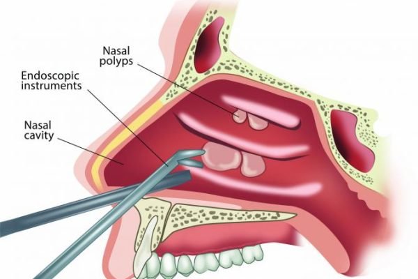 nasal-polyps